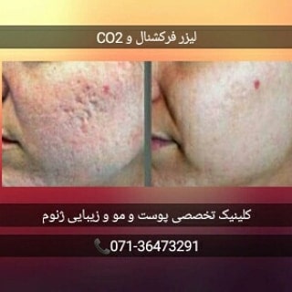 لیزر فرکشنال و CO2